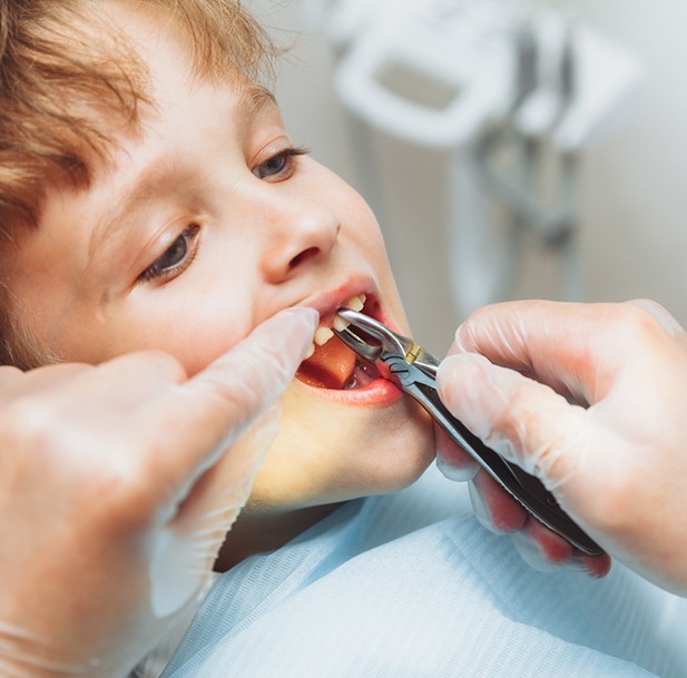 Gloved hands grasping little boy’s tooth with forceps